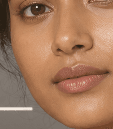 rhea kapoor, patient at MIGAKKI Skin & Hair Clinic