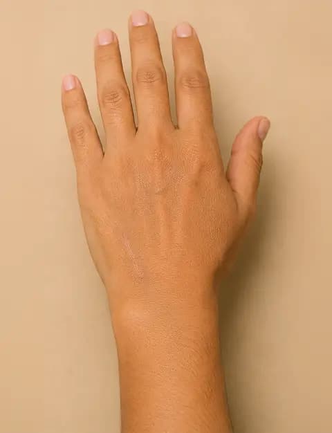 After Lipoma Surgery at MIGAKKI Skin & Hair Clinic